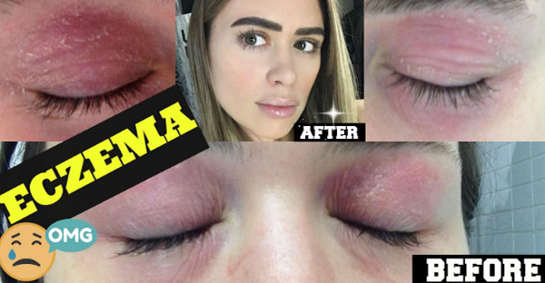 My Eczema Cure: How a Plant: Based Diet Saved My Skin